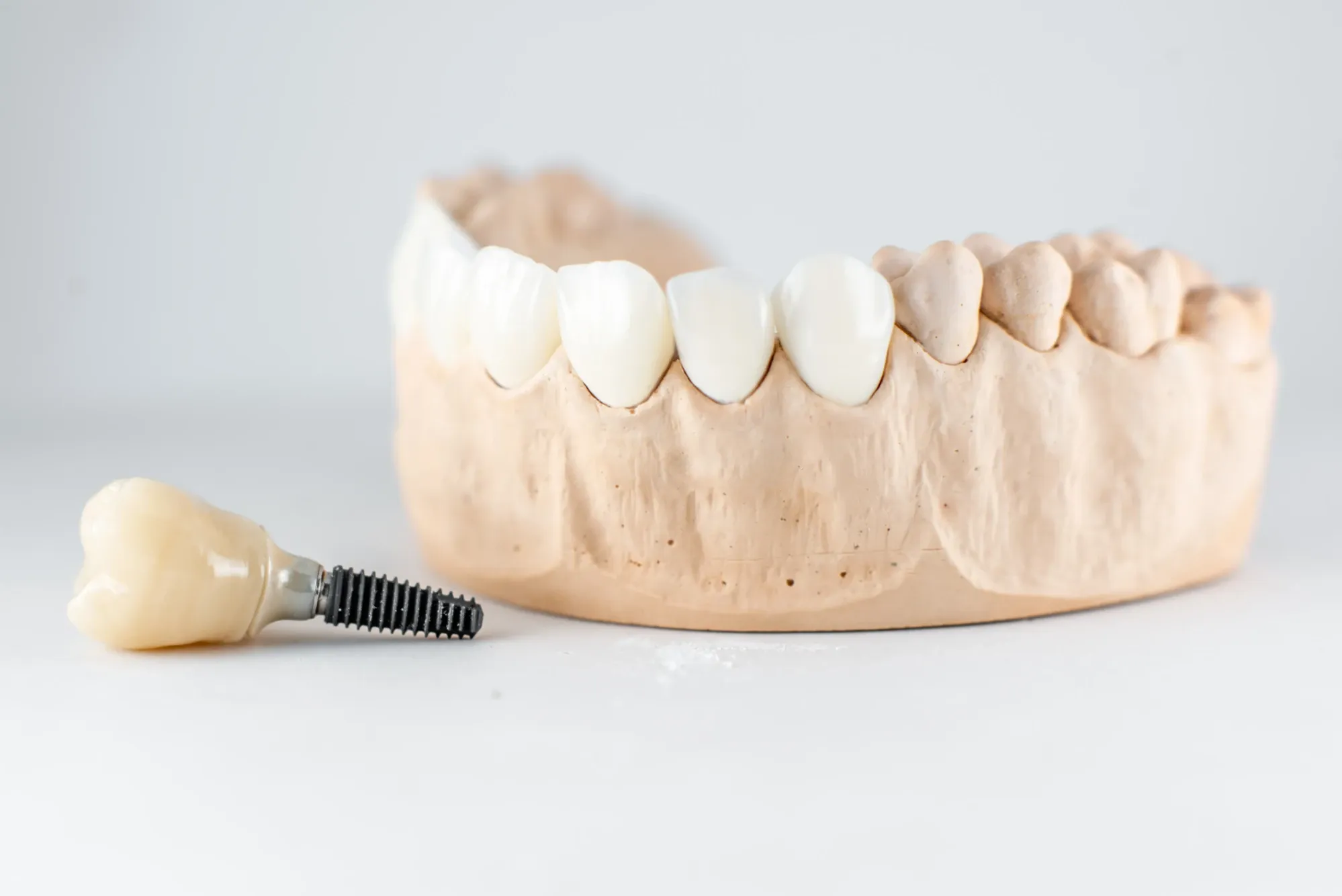 Implantat oder Brücke – was ist besser?