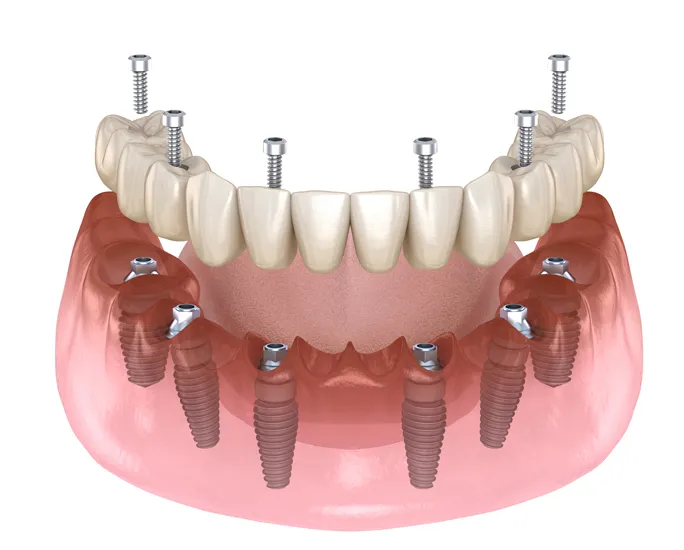 Implant-Supported Titanium Bar Fabrication