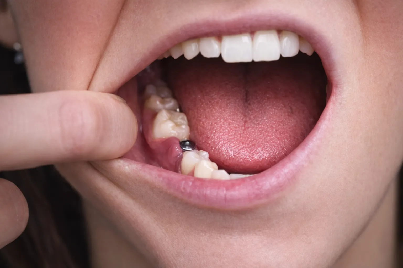 Heilung nach der Implantatoperation