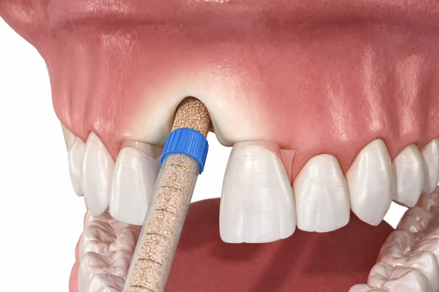Was ist ein Knochenaufbau (Knochenaugmentation)?