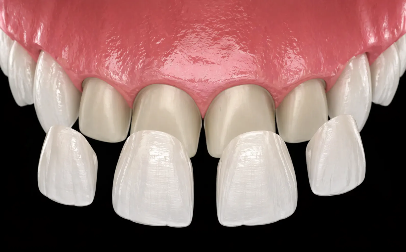 Verblendung oder Laminat – was ist besser?