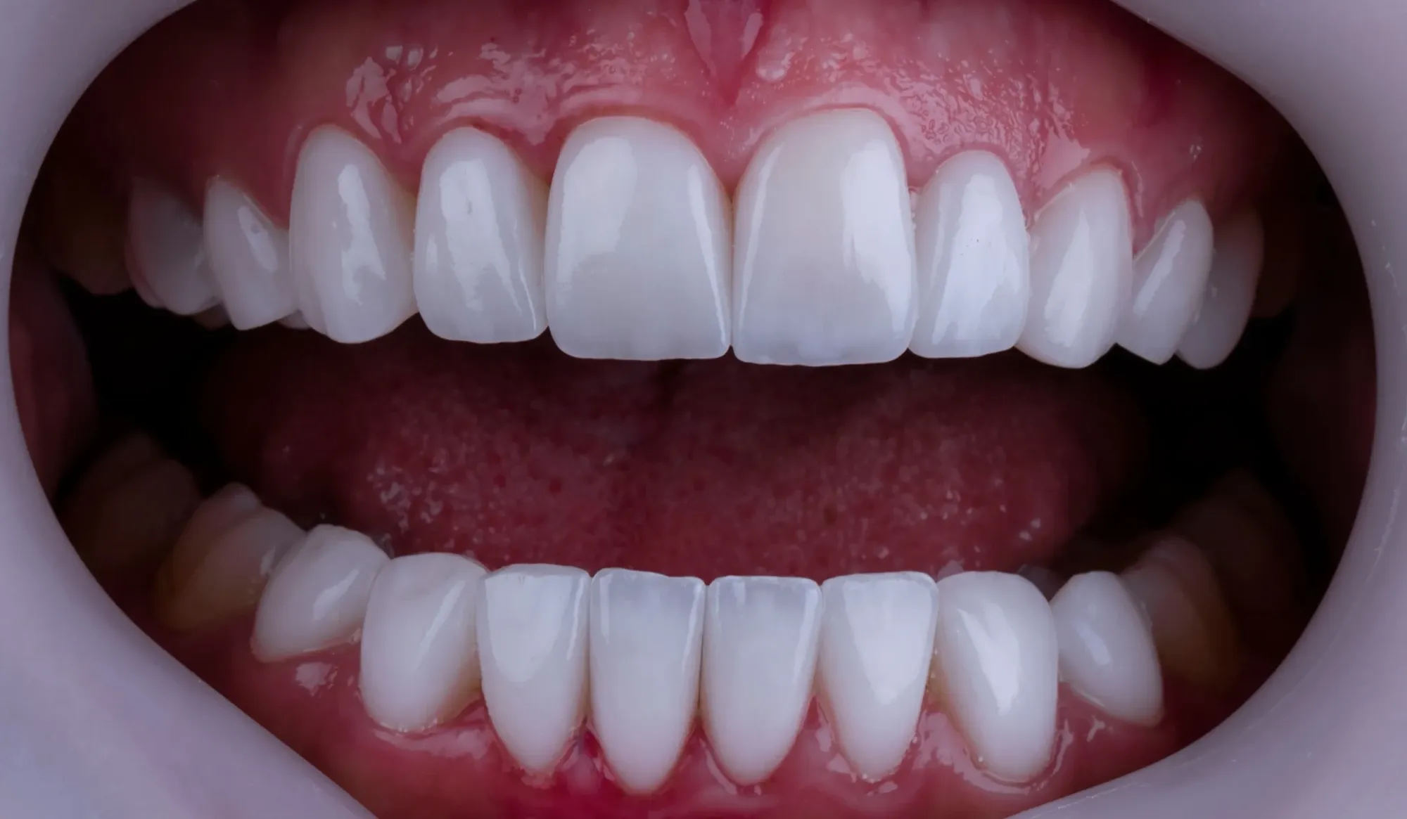 Full-Mouth (Complete Dental Restoration)